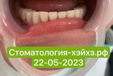 Наши_работы_Протезирование2023_05_2