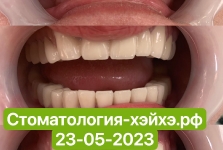 Наши_работы_Протезирование2023_05_3