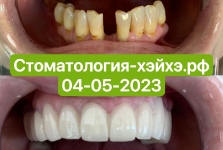 Наши_работы_Протезирование2023_05_4