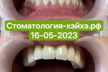 Наши_работы_Протезирование2023_05_5