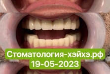 Наши_работы_Протезирование2023_05_6
