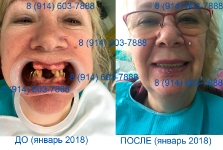 Протезирование в январе 2018_1